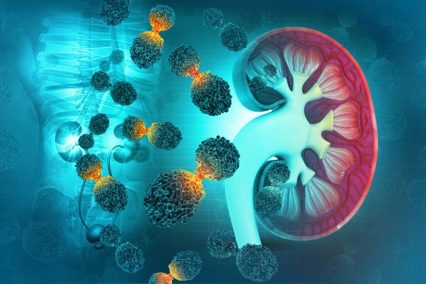Key Risk Factors and Metastasis Trends in Kidney Cancer Key Risk Factors and Metastasis Trends in Kidney Cancer